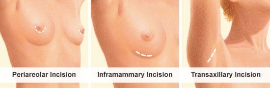 breast augmentation incision locations