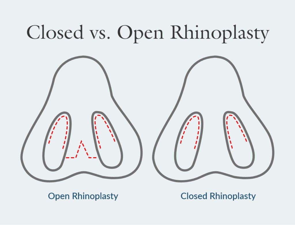 rhinoplasty incision locations