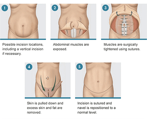 tummy tuck incision locations