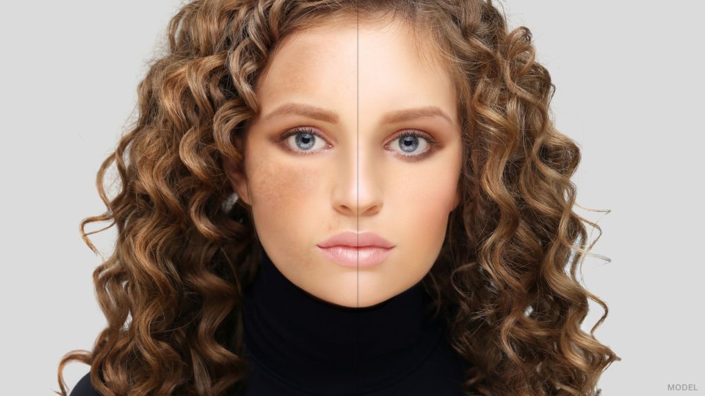 Woman showing before & after results of reversing sun damage (model)