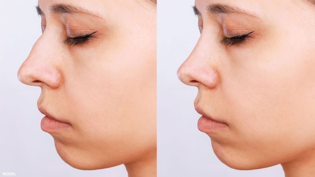 Before and after images of woman after Rhinoplasty (model)