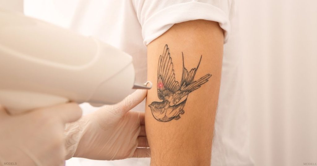 Laser tattoo removal treatment on a bird tattoo on a person’s arm (models)