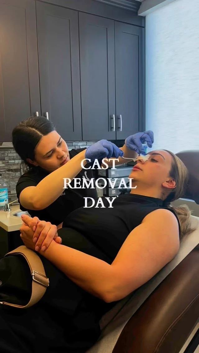 Cast removal days are our favorite👃🏼
.
#drvartany #rhinoplasty #nosejobtransformation #beforeandafter #surgeonsofla #burbank #hollywood