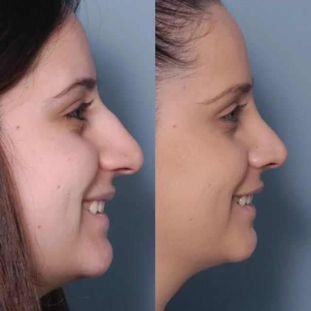 The rhinoplasty of our dreams✨

To schedule an appointment or consultation:
☎️(818)500-0823 
🔗www.Vartany.com

#rhinoplasty #nosejob #beforeandafter #drvartany #losangeles #burbank #plasticsurgeon