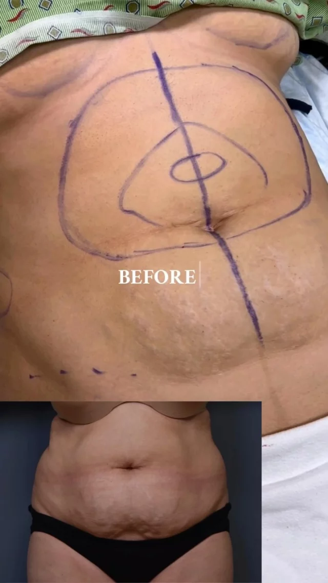 A behind-the-scenes look inside the OR🔪✨ Tummy tuck with liposuction in action — removing excess fat, tightening the core, and sculpting a smoother, more defined waistline. 

#mondaymotivations #abdominoplasty #drvartany #tummytuckmotivation #surgeryday