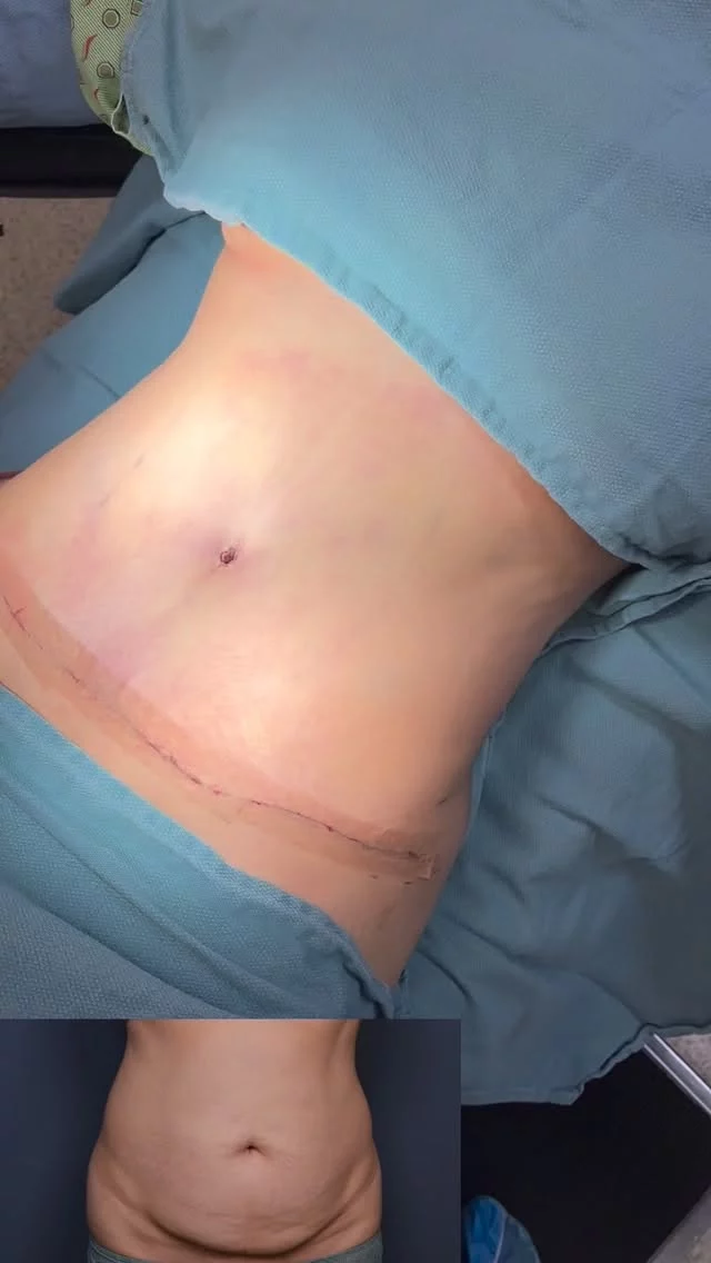 This beautiful patient wanted to restore her abdominal contour after weight changes and skin laxity.
We performed a Tummy Tuck with Liposuction to achieve a flatter, tighter, and more sculpted abdomen — while maintaining her natural proportions. ✨

Our Abdominoplasty + Lipo procedure includes:
1️⃣ Removal of excess skin and fat
2️⃣ Muscle tightening (rectus plication)
3️⃣ Targeted liposuction for enhanced contouring and definition

✨ After photo shown is immediately after surgery. It was a pleasure taking care of her and helping her begin her transformation journey. ❤️🙏

For questions on pricing and appointments, call us at 818.500.0823

📞 Phone: 818.500.0823
📧 Email: frontdesk@vartany.com
🌐 Website: http://www.vartany.com
📍 Location: 116 S Buena Vista St, Ste 300, Burbank, CA 91505

#tummytuck #abdominoplasty #liposuction #lipo360 #mommymakeover #bodycontouring #burbankplasticsurgery #drvartany #beforeandafter #confidenceboost #tummytuckjourney #burbank #plasticsurgery #naturalresults