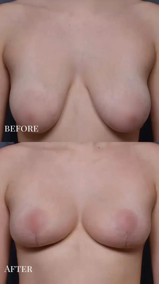 #Results that will have you #SCREAM with #joy 😱

A beautiful, #natural #breastlift using the patient’s own #breast tissue.  Youthful result without #implants