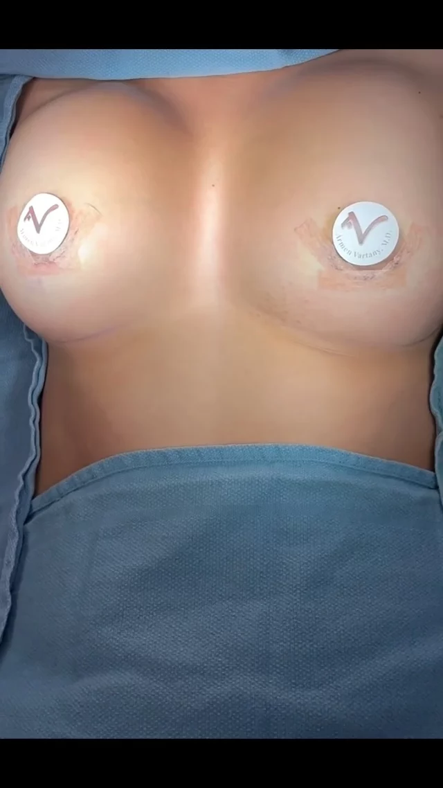 This beautiful patient wanted to restore volume and enhance her natural shape.
We performed a Breast Augmentation using Allergan 650 cc implants to achieve a fuller, balanced, and natural-looking result that complements her proportions perfectly. ✨

Our Breast Augmentation procedure focuses on:
1️⃣ Personalized implant selection for body harmony
2️⃣ Creating natural contour and symmetry
3️⃣ Enhancing confidence while maintaining proportion

For questions on pricing and appointments, text or call us at 818.500.0823

📞 Phone: 818.500.0823
📧 Email: frontdesk@vartany.com
🌐 Website: http://www.vartany.com
📍 Location: 116 S Buena Vista St, Ste 300, Burbank, CA 91505

#breastaugmentation #breastimplants #allerganimplants #drvartany #burbankplasticsurgery #naturalresults #confidenceboost #beforeandafter #mommymakeover #bodycontouring #burbankbeauty