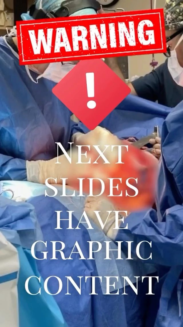 Incredible #behindthescenes look during a major #tummytuck #transformation

#bodybyvartany #selfcare #dowhatsgoodforyou #abdominoplasty #bestplasticsurgeon #lifechanging
