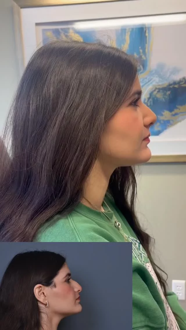 Only 3 weeks post-op and the best is yet to come 🤭 

#rhinoplasty #drvartany #naturalrhinoplasty #naturalrhinoplastyresults