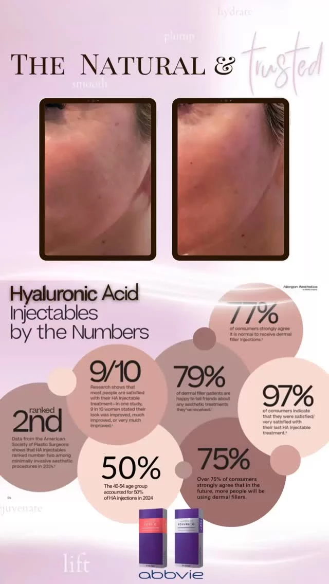 The #Juvederm family of #Hyaluronicacid #fillers are a #trusted tool for #stimulating and #plumping your face and it’s #youthful #elements 💦 

@juvederm @skinvive @allerganaesthetics @alle