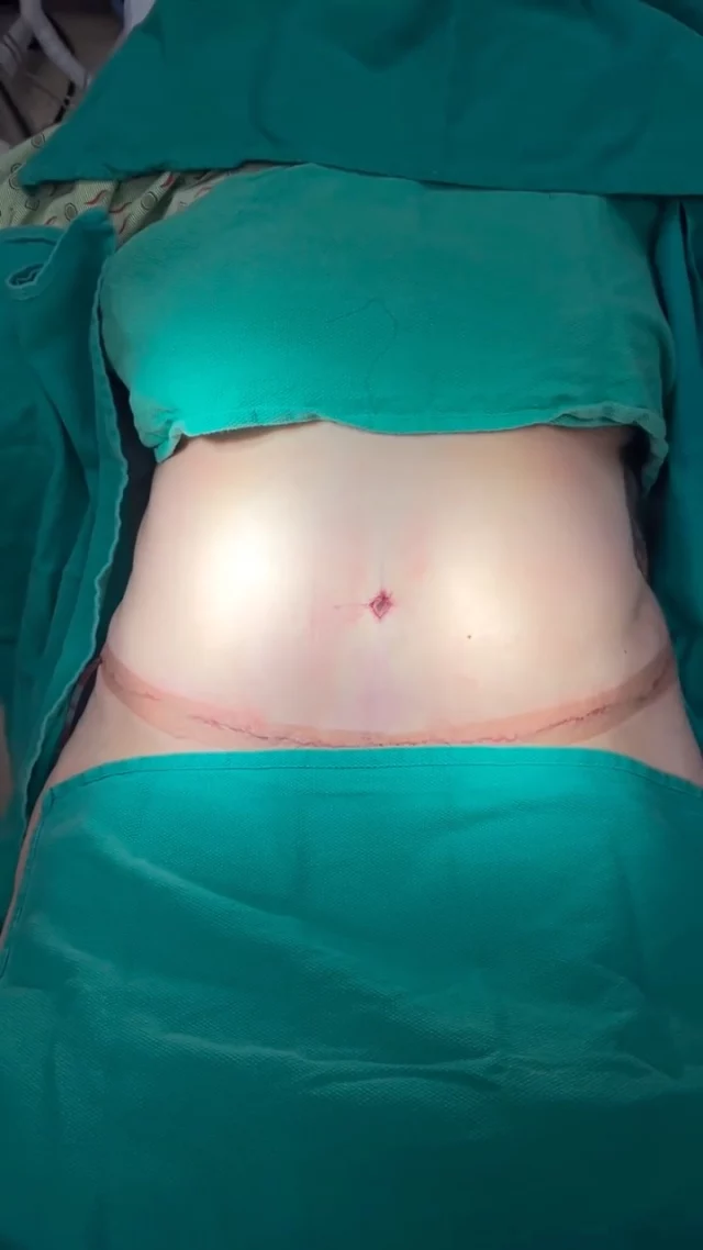 This lovely patient came to us looking to restore her abdominal contour after weight fluctuations and skin laxity. To achieve a smoother, firmer, and more sculpted midsection, we performed a Tummy Tuck combined with Liposuction, carefully enhancing her shape while preserving natural, balanced proportions. ✨

Abdominoplasty + Liposuction includes:
✔️ Removal of excess skin and stubborn fat
✔️ Muscle tightening (rectus plication) to strengthen the core
✔️ Precision liposuction for improved contour and definition

✨ After photo shown is taken immediately following surgery. It was truly a pleasure caring for her and being part of the start of her transformation journey. ❤️🙏

📞 For pricing details or to schedule a consultation, contact us:
📱 818.500.0823
📧 frontdesk@vartany.com
🌐 www.vartany.com
📍 116 S Buena Vista St, Ste 300, Burbank, CA 91505

#tummytuck #abdominoplasty #liposuction #lipo360 #bodycontouring mommymakeover