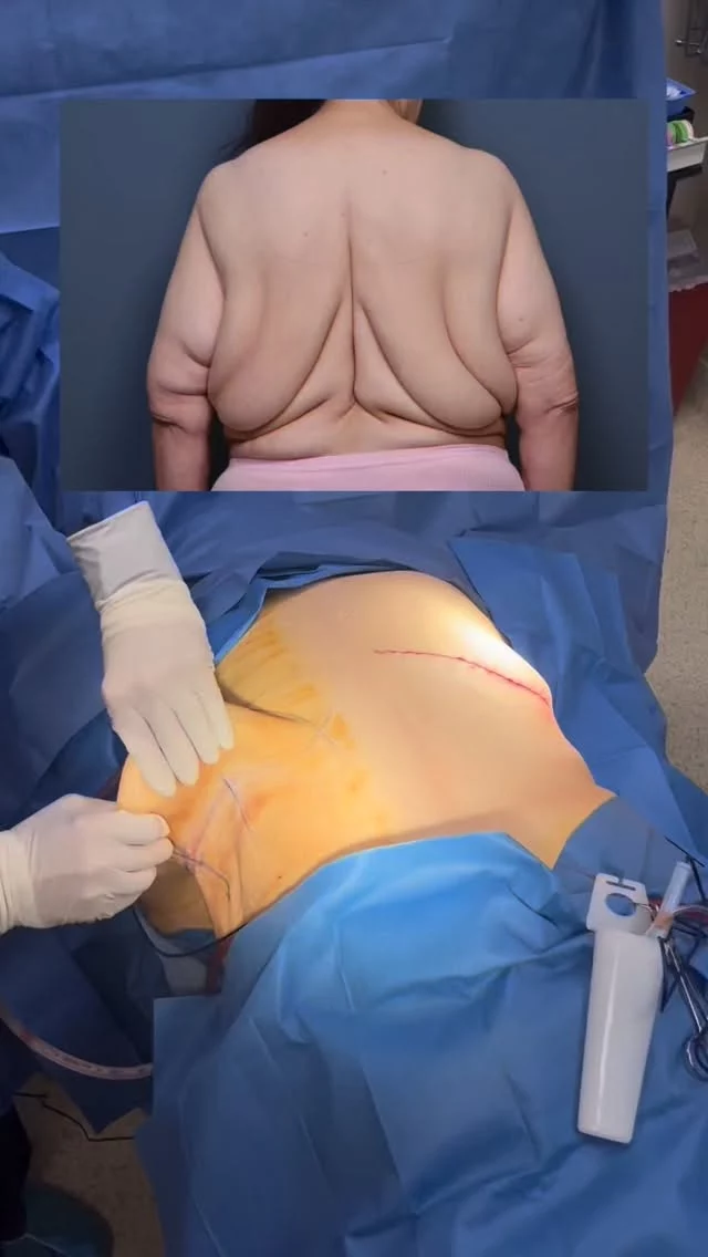 ✨ Did you know a back lift is one of the most underrated body contouring procedures? ✨

After massive weight loss, the back can be left with loose skin that diet and exercise alone can’t correct. A back lift removes excess skin and tightens the area to restore smoother, more balanced contours.

This patient lost 130 pounds, an incredible achievement — and this procedure helps complete that transformation by addressing areas often overlooked.

📸 What you’re seeing: one side of the back has been fully completed, while the other side has not yet been treated — highlighting the dramatic difference this procedure can make.

Back lifts may be underrated, but for the right patient, they can be truly life-changing.

📍 Performed by Dr. Vartany
🌐 www.vartany.com
📞 818-500-0823
📧 frontdesk@vartany.com
📍 116 S Buena Vista St, Ste 300, Burbank, CA 91505

#BackLift #BodyContouring #MassiveWeightLoss
#UnderratedProcedure #bodylift