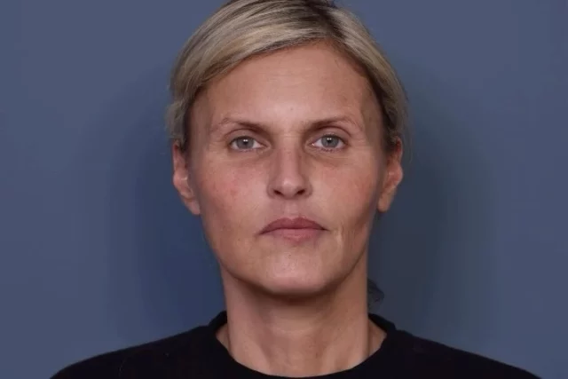 What is a deep plane facelift — and why does it look so natural?

As we age, the face and neck don’t just develop wrinkles — the deeper tissues begin to shift downward. This leads to jowls, heaviness along the jawline, deep smile lines, and loose skin in the neck.

A deep plane facelift corrects aging at its source.

Instead of simply tightening skin, this advanced technique releases and lifts the deeper structural layer of the face and neck. By repositioning these tissues back to where they once were, we restore youthful contours without creating tension.

The result:
• A defined jawline
• A smoother, tighter neck
• Softer folds around the mouth
• Natural movement and expression

Just a refreshed, rested version of you.

—

📍 Dr. Vartany
🌐 www.vartany.com
📞 818-500-0823
📧 frontdesk@vartany.com
📍 116 S Buena Vista St, Ste 300
Burbank, CA 91505

#DeepPlaneFacelift #FacialRejuvenation #NeckLift #NaturalResults #DrVartany