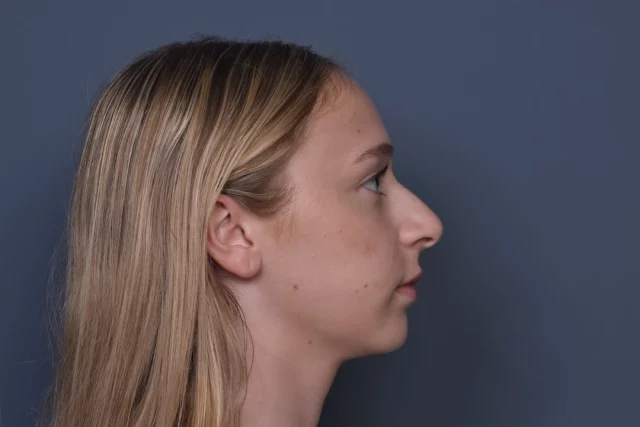 A refined nose can completely balance the face. ✨
This rhinoplasty result enhances the patient’s natural features while maintaining harmony and proportion.

Subtle changes. Beautiful results.

Swipe to see the transformation at every angle 🥹➡️🤭

To schedule a consultation with Dr. Vartany:

📞 (818) 500-0823
🌐 www.vartany.com
📧 frontdesk@vartany.com
📍 Burbank, California

#rhinoplasty #nosejob #plasticsurgery #facialbalance #drvartany burbankplasticsurgery rhinoplastyresults